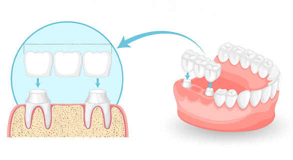 Dental Bridge