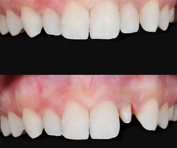 Dental Crown