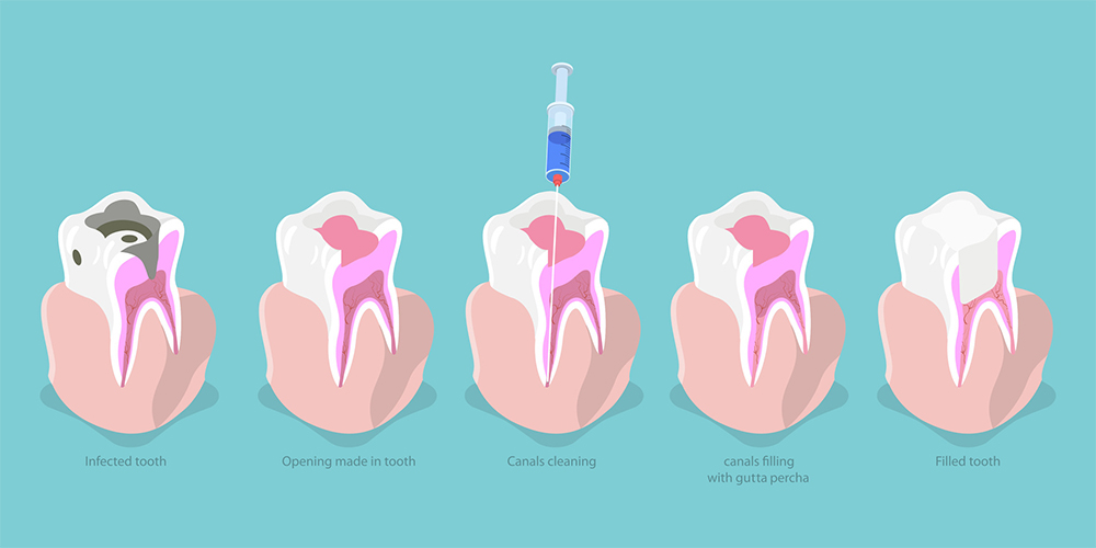 Tooth Decay