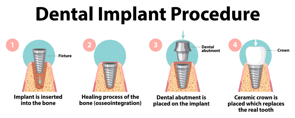 Dental Implant Procedure