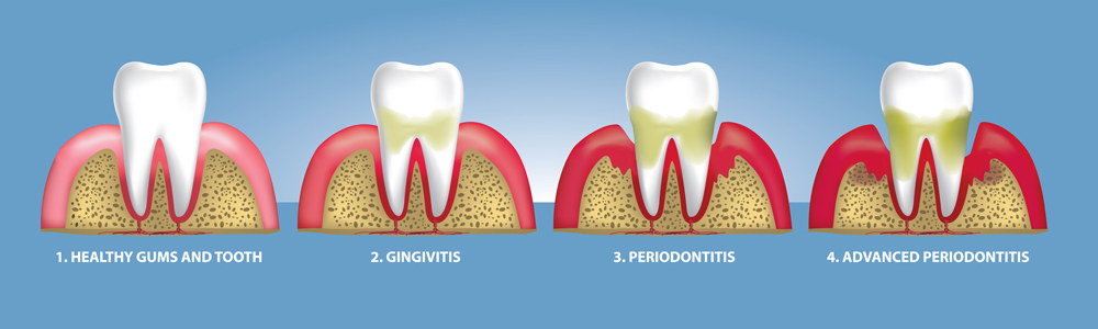Tooth Gum Disease