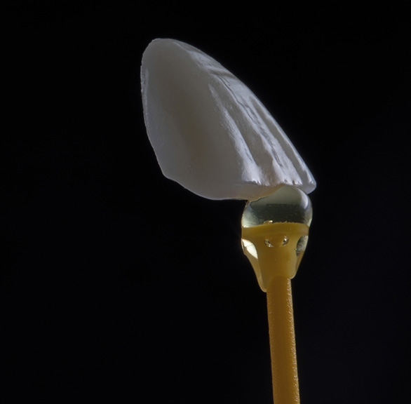 Porcelain Veneers